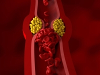 DOK NE POTVRDI LABORATORIJA: Bol u ovim djelovima tijela može ukazati na visok holesterol