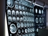 STUDIJA POKAZALA:  Alzheimerova bolest češća među radno sposobnim ljudima