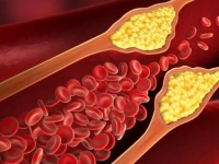NEOČEKIVANI REZULTATI NOVOG ISTRAŽIVANJA: Ukoliko imate visok kolesterol, mogli biste se naći u velikoj opasnosti...